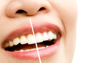 How Long Does Professional Teeth Whitening Last? Tips for Bright Smile