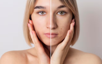 Hyperpigmentation Soap