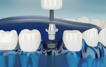 dental implants coventry