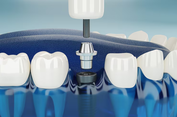 Dental Implants in Coventry: What to Expect & How They Work