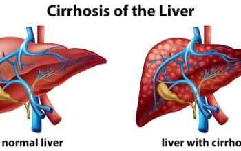 Medical illustration comparing a normal liver and a liver affected by cirrhosis caused by alcohol damage