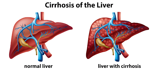 Alcohol vs Non-Alcoholic Cirrhosis: Key Differences